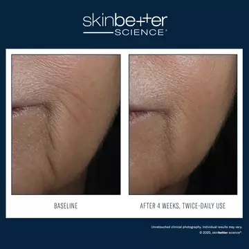 InterFuse Intensive Treatment LINES